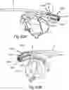 Fig. 104 - SURGICAL INSTRUMENT FOR A SUBCUTANEOUS DEVICE
