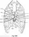 Fig. 106 - SURGICAL INSTRUMENT FOR A SUBCUTANEOUS DEVICE