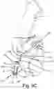 Fig. 14 - SURGICAL INSTRUMENT FOR A SUBCUTANEOUS DEVICE