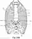 Fig. 35 - SURGICAL INSTRUMENT FOR A SUBCUTANEOUS DEVICE