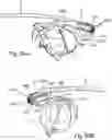 Fig. 93 - SURGICAL INSTRUMENT FOR A SUBCUTANEOUS DEVICE