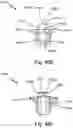 Fig. 83 - SURGICAL INSTRUMENT FOR A SUBCUTANEOUS DEVICE