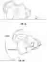 Fig. 02 - Coupled torsional fixator and method of use