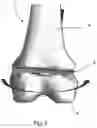 Fig. 09 - Coupled torsional fixator and method of use