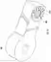 Fig. 24 - External fixation strut