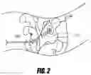 Fig. 03 - Medical device and method to correct deformity