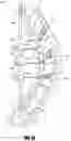 Fig. 14 - Medical device and method to correct deformity