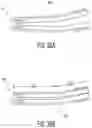 Fig. 21 - Intramedullary implant and method of use