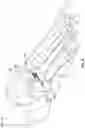 Fig. 21 - Modular bone implant devices and means of insertion