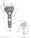 Fig. 04 - Distal radius stabilization system