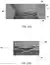 Fig. 20 - Distal radius stabilization system