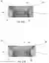 Fig. 22 - Distal radius stabilization system