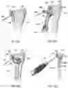 Fig. 30 - Distal radius stabilization system