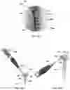 Fig. 31 - Distal radius stabilization system