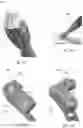 Fig. 32 - Distal radius stabilization system