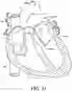 Fig. 27 - Endovascular near critical fluid based cryoablation catheter and related methods
