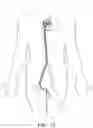 Fig. 28 - Endovascular near critical fluid based cryoablation catheter and related methods