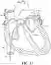 Fig. 29 - Endovascular near critical fluid based cryoablation catheter and related methods