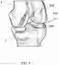 Fig. 13 - Surgical device with movement compensation