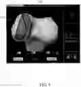 Fig. 14 - Surgical device with movement compensation