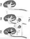 Fig. 02 - Magnetic wire for retrieval and elimination of calculus from the urinary tract