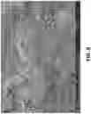 Fig. 10 - Magnetic wire for retrieval and elimination of calculus from the urinary tract