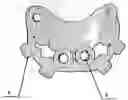 Fig. 01 - SURGICAL GUIDE PLATE AND PREPARATION METHOD THEREFOR
