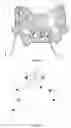 Fig. 06 - SURGICAL GUIDE PLATE AND PREPARATION METHOD THEREFOR