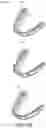 Fig. 12 - ALIGNER STAGE ANALYSIS TO OBTAIN MECHANICAL INTERACTIONS OF ALIGNERS AND TEETH FOR TREATMENT PLANNING