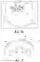 Fig. 04 - Fixation base and guides for dental prosthesis installation