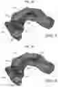 Fig. 17 - Method of generating three dimensional model using virtual bridge based multi input Boolean operation