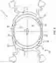 Fig. 05 - Intraocular Refractive Phakic Lens and Method