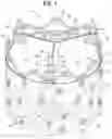 Fig. 02 - PROSTHETIC HEART VALVE HAVING AT LEAST TWO TYPES OF STRUTS