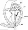 Fig. 01 - Valve delivery system having an integral displacement component for managing chordae tendineae in situ and methods of use thereof