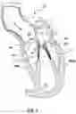 Fig. 03 - Valve delivery system having an integral displacement component for managing chordae tendineae in situ and methods of use thereof