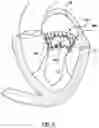 Fig. 04 - Valve delivery system having an integral displacement component for managing chordae tendineae in situ and methods of use thereof