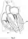 Fig. 05 - Valve delivery system having an integral displacement component for managing chordae tendineae in situ and methods of use thereof
