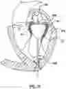 Fig. 11 - Valve delivery system having an integral displacement component for managing chordae tendineae in situ and methods of use thereof