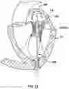 Fig. 12 - Valve delivery system having an integral displacement component for managing chordae tendineae in situ and methods of use thereof