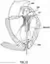 Fig. 13 - Valve delivery system having an integral displacement component for managing chordae tendineae in situ and methods of use thereof