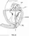 Fig. 14 - Valve delivery system having an integral displacement component for managing chordae tendineae in situ and methods of use thereof