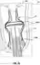 Fig. 24 - Valve delivery system having an integral displacement component for managing chordae tendineae in situ and methods of use thereof
