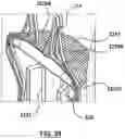 Fig. 25 - Valve delivery system having an integral displacement component for managing chordae tendineae in situ and methods of use thereof