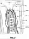 Fig. 26 - Valve delivery system having an integral displacement component for managing chordae tendineae in situ and methods of use thereof