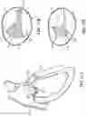 Fig. 15 - TRICUSPID VALVE REPAIR DEVICES AND ASSOCIATED SYSTEMS AND METHODS