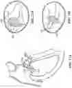 Fig. 26 - TRICUSPID VALVE REPAIR DEVICES AND ASSOCIATED SYSTEMS AND METHODS