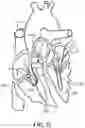 Fig. 27 - TRICUSPID VALVE REPAIR DEVICES AND ASSOCIATED SYSTEMS AND METHODS