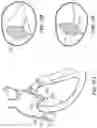Fig. 30 - TRICUSPID VALVE REPAIR DEVICES AND ASSOCIATED SYSTEMS AND METHODS