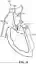 Fig. 31 - TRICUSPID VALVE REPAIR DEVICES AND ASSOCIATED SYSTEMS AND METHODS