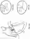 Fig. 108 - CARDIAC VALVE REPAIR DEVICES AND ASSOCIATED SYSTEMS AND METHODS
